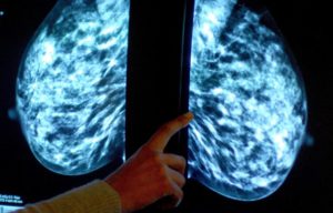 where to get free mammograms free breast cancer screenings where i can get free breast cancer screening