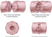 What Makes the Vasectomy Reversal Success Rate High?