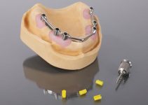 How To Get Free Dental Implants or Cheap Programs Today How To Get Free Dental Implants or Cheap Programs Today