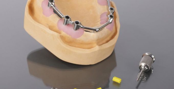 How To Get Free Dental Implants or Cheap Programs Today