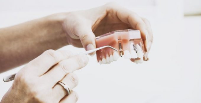 Mini Dental Implant Cost And Procedure You Must Know